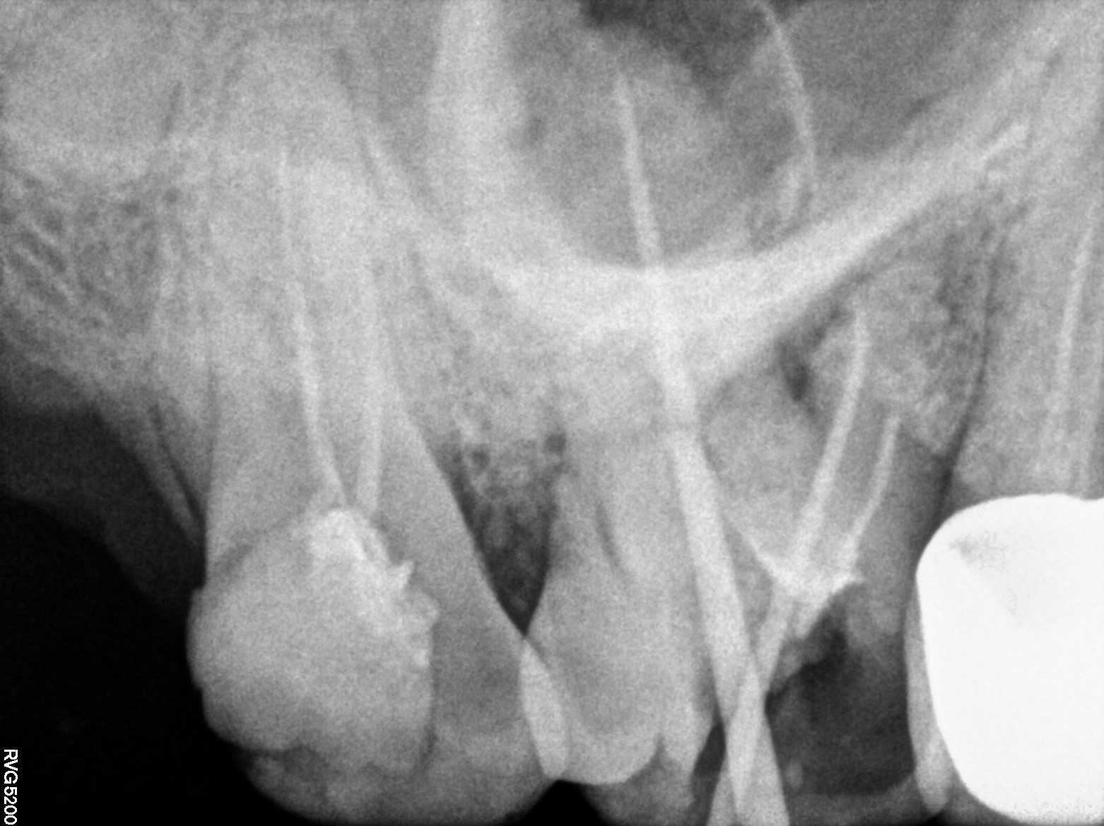 Dental X-ray